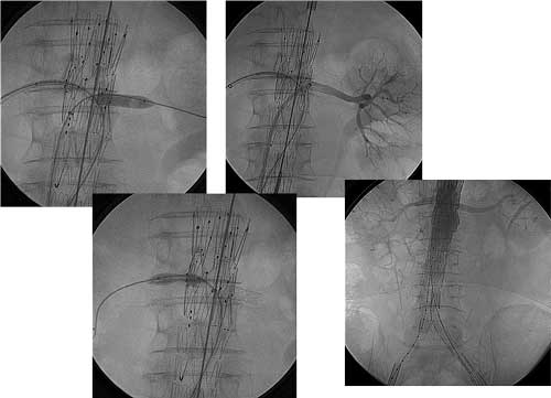 Procedimento endovascular com posicionamento dos stents em ambas fenestras para artérias renais