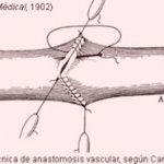 Técnica de sutura vascular descrita por Carrel