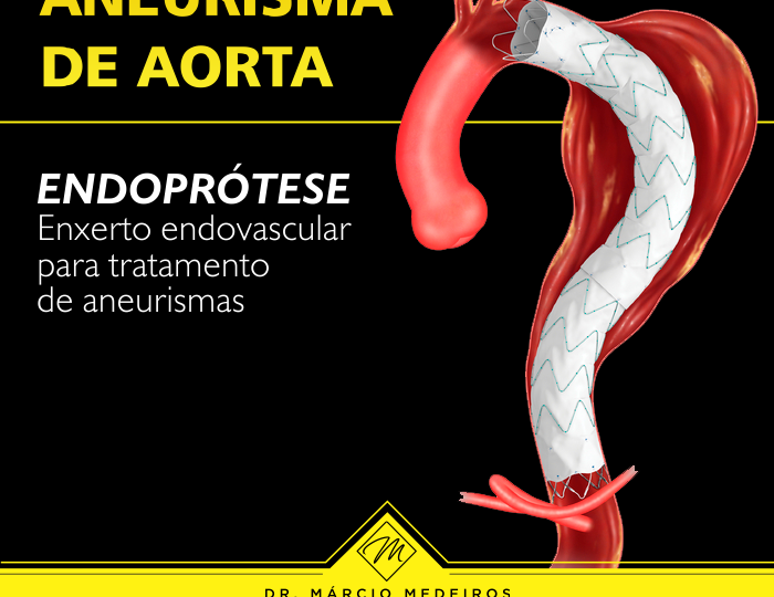Endoprótese para o tratamento de aneurisma de aorta