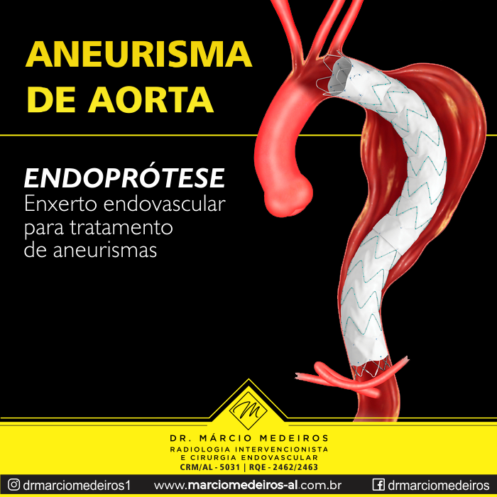Aneurisma de aorta maceió